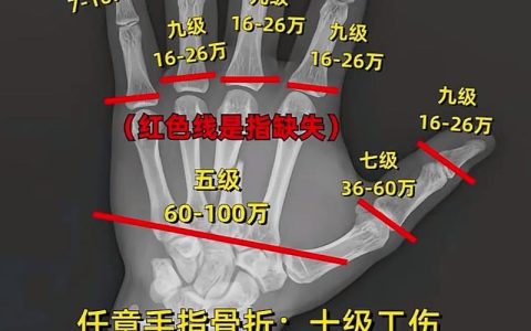哪些骨折算十级伤残：标准与案例全解析