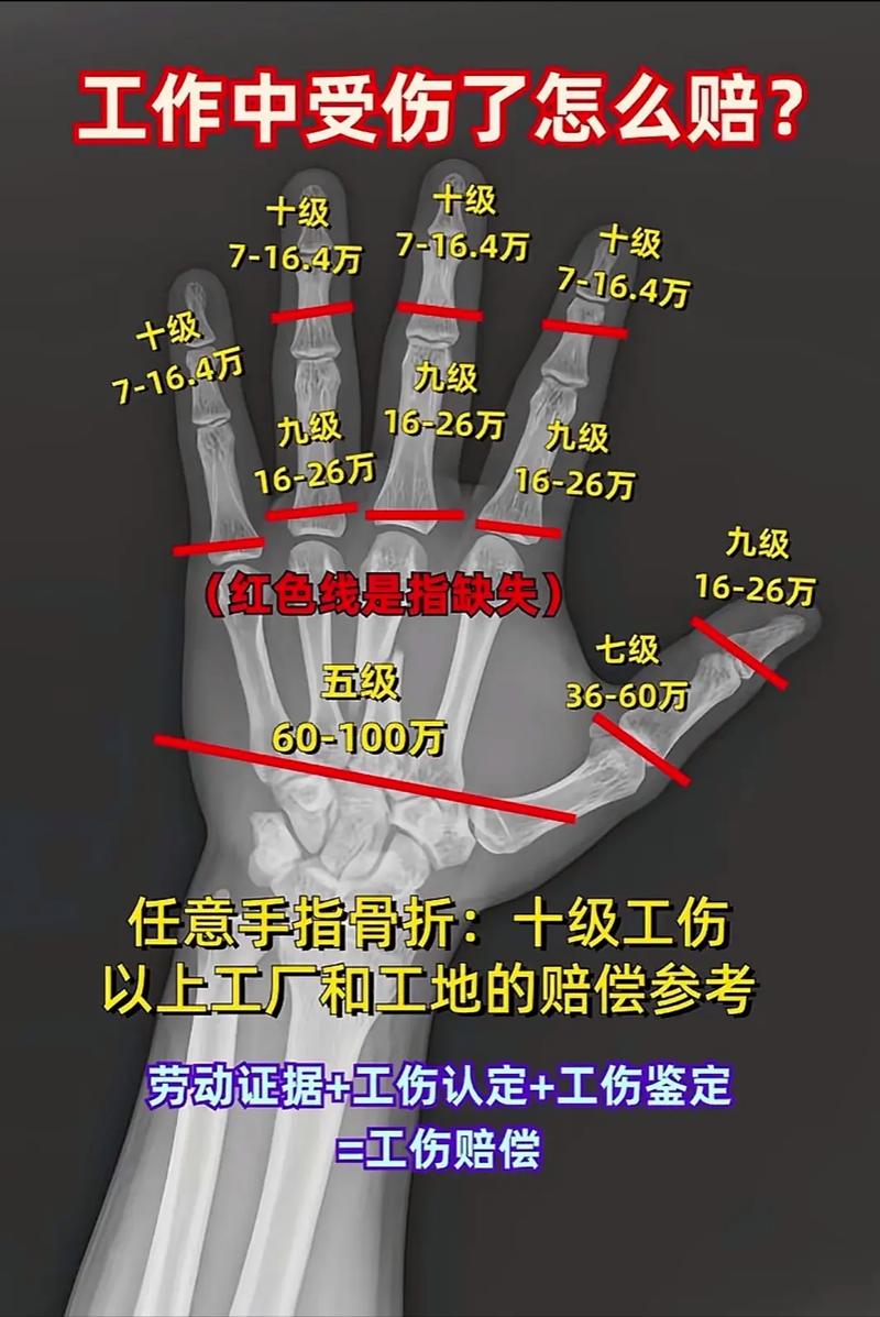 哪些骨折算十级伤残：标准与案例全解析