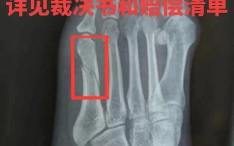 农民工工伤骨折赔偿标准全解析