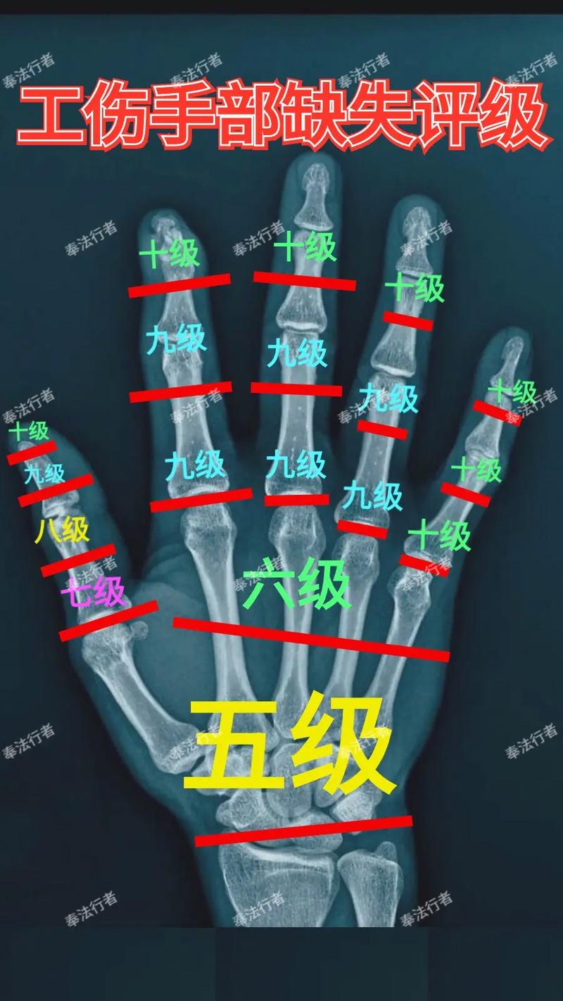 手指怎样才算十级伤残？标准与赔偿全解析