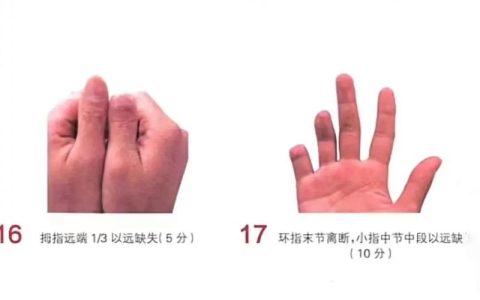 手指伤残十级认定标准与鉴定流程详解