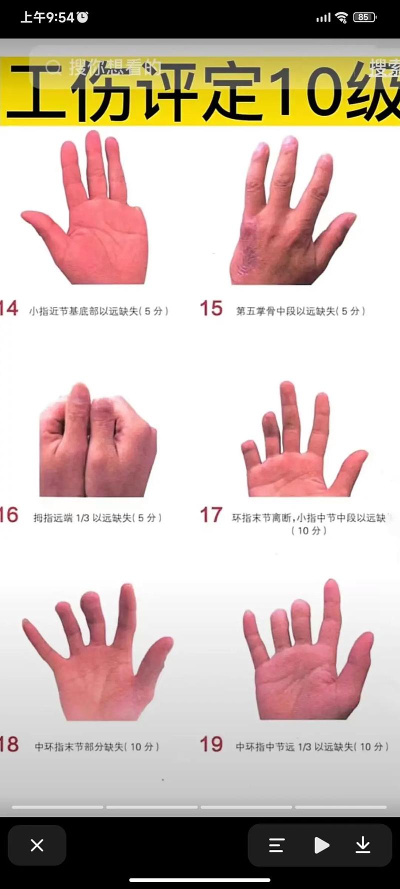 手指伤残十级认定标准与鉴定流程详解