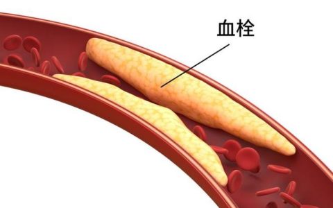 腿部血栓定伤残：医学鉴定与赔偿全程指南