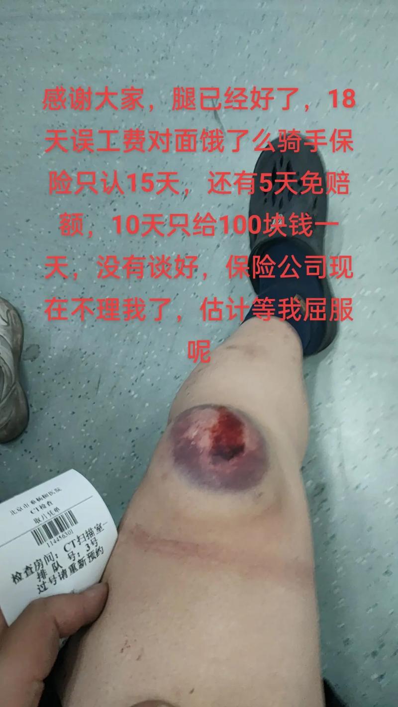 骑手撞人全责赔偿详解：金额构成与影响因素分析