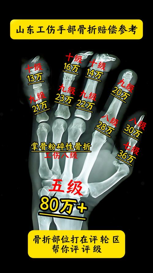 骨折后如何判定十级伤残？权威解读与实务指南