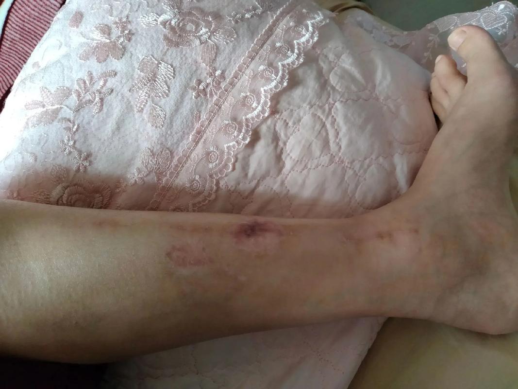 骨折误工费如何计算？权威解析