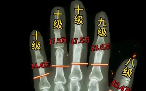 人身损害伤残等级鉴定标准详解