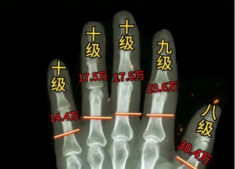 人身损害伤残等级鉴定标准详解