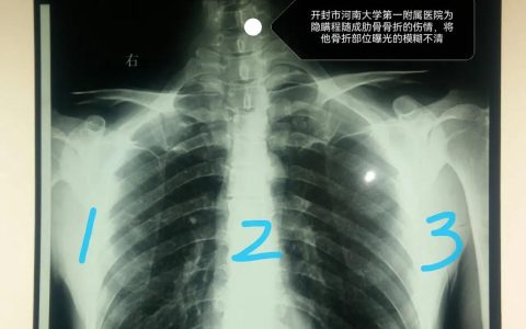 两根肋骨骨折的伤情认定与赔偿标准
