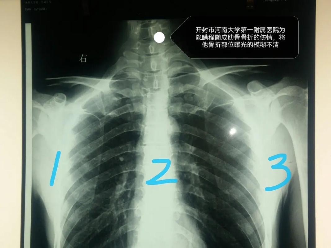 两根肋骨骨折的伤情认定与赔偿标准