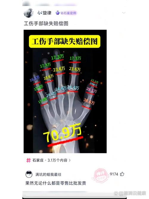 手指十级伤残认定标准与赔偿指南