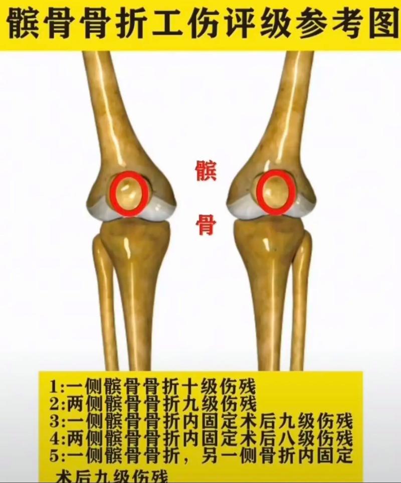 七旬老人车祸骨折，赔偿标准与维权指南