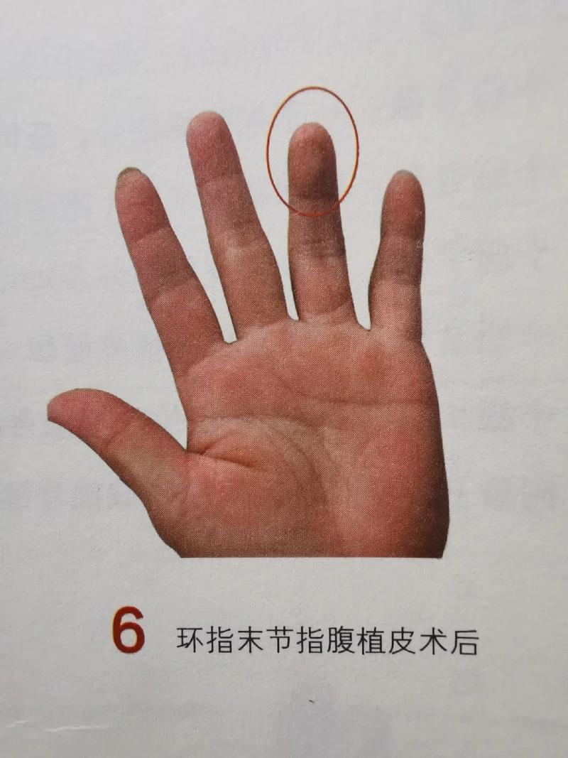 手指受伤非小事：伤残等级鉴定与影响深度解析