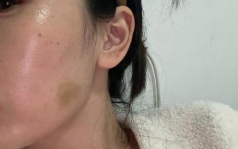 打架后验伤有效期多长？权威解读与维权关键点