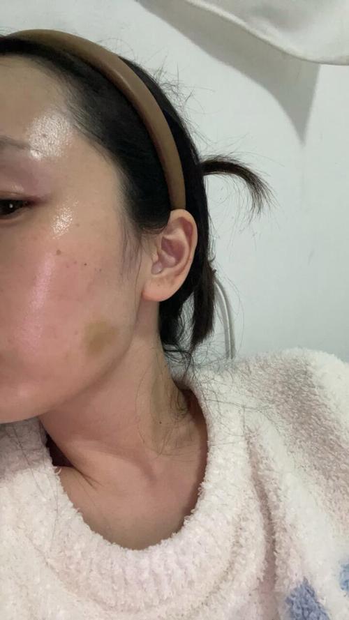 打架后验伤有效期多长？权威解读与维权关键点