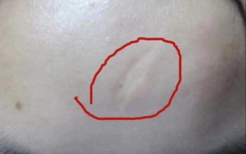 额头疤痕三厘米算不算伤残？权威解读与指引