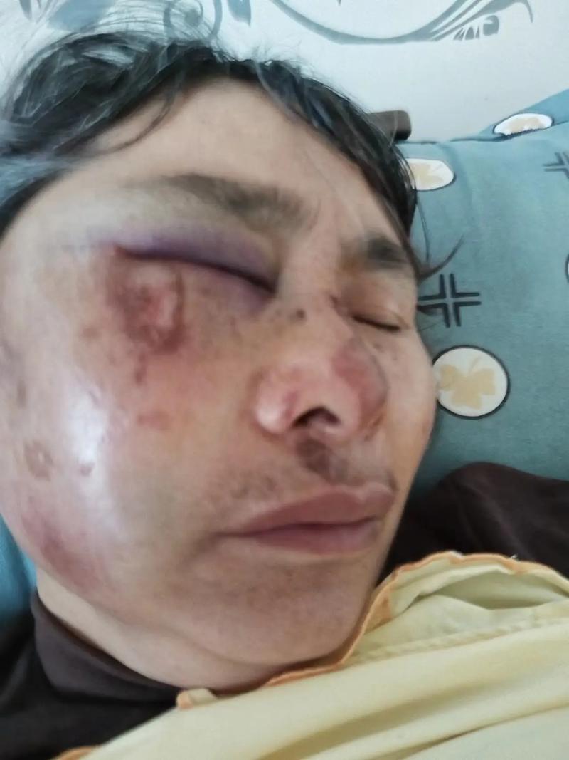脸被打肿了？轻微伤还是轻伤？权威解读与维权指南