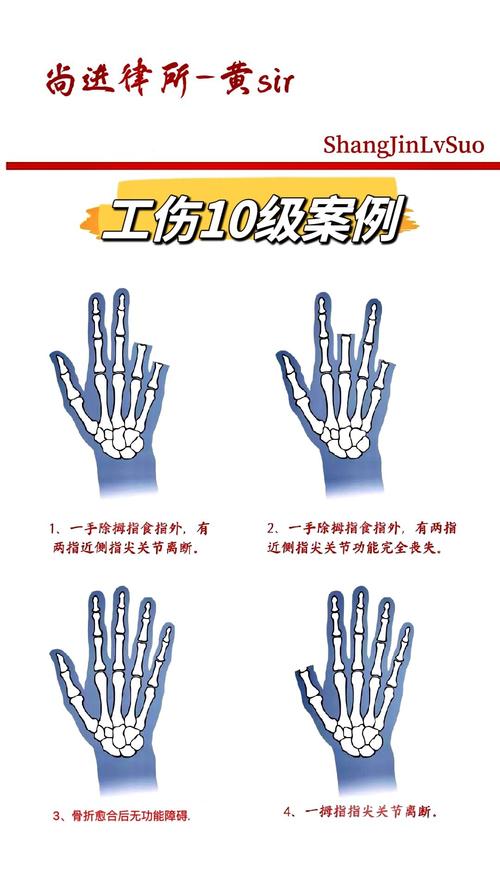 双手骨折伤残等级评定与赔偿要点解析