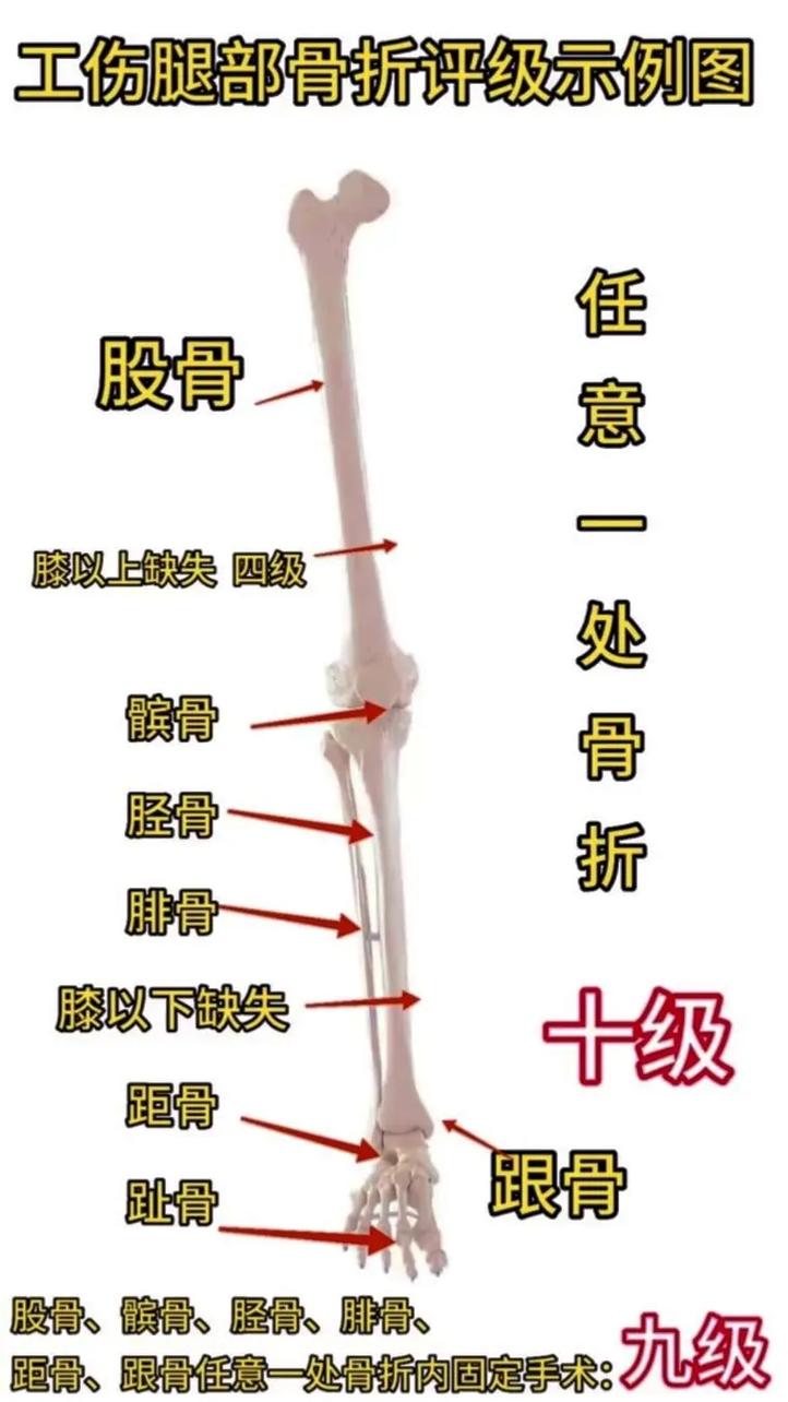 骨折伤残等级评定：标准与赔偿解析