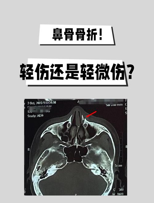 鼻骨骨折赔偿金额一般是多少