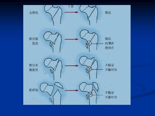 骨折赔偿金额如何确定？