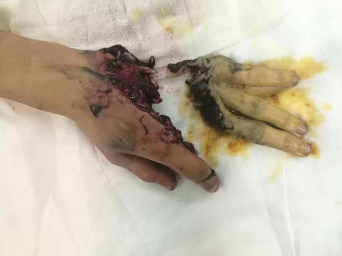 十级伤残认定标准详解与赔偿指南